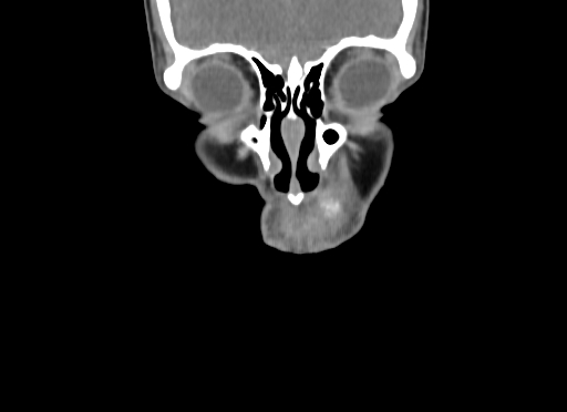 Chondroblastic osteosarcoma (Radiopaedia 67363-76741 D 14).jpg