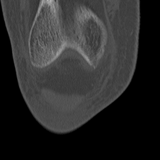Chondrocalcinosis (Radiopaedia 16275-15955 Coronal bone window 14).jpg