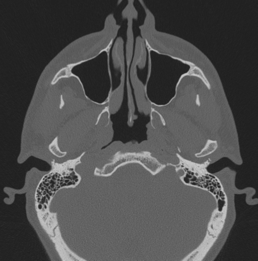 Chondrosarcoma (clivus) (Radiopaedia 46895-51425 Axial bone window 61).png