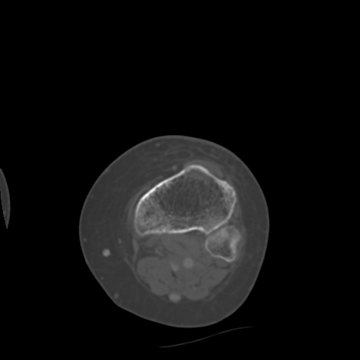 Chondrosarcoma - femur (Radiopaedia 64187-72954 Axial bone window 64).jpg