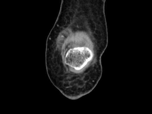 Chondrosarcoma - femur (Radiopaedia 64187-72954 C 6).jpg