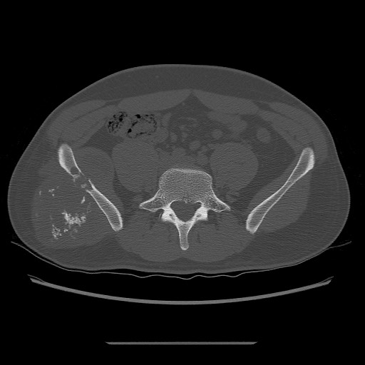 File:Chondrosarcoma of iliac wing (Radiopaedia 63861-72599 Axial bone window 40).jpg