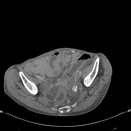 File:Chondrosarcoma of the spine (Radiopaedia 49871-55143 A 53).jpg
