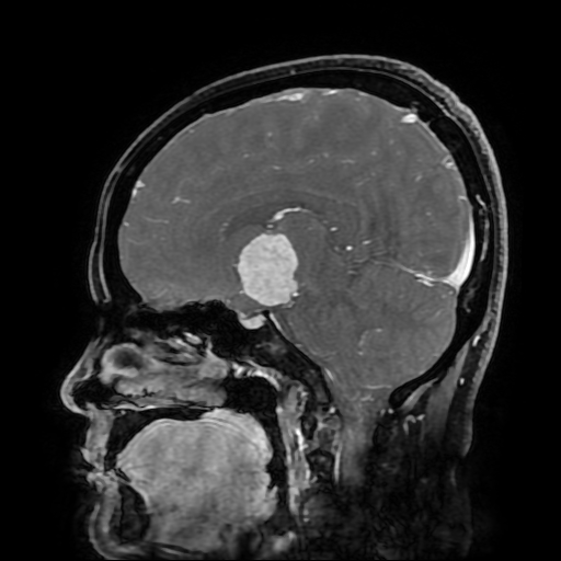 File:Chordoid glioma of third ventricle (Radiopaedia 91612-109340 F 100).jpg