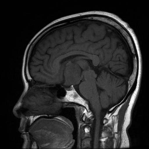 File:Chordoid glioma of third ventricle (Radiopaedia 91612-109340 Sagittal T1 12).jpg