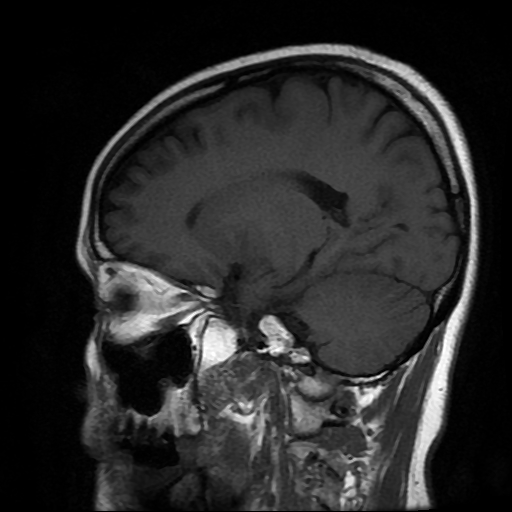 File:Chordoid glioma of third ventricle (Radiopaedia 91612-109340 Sagittal T1 17).jpg