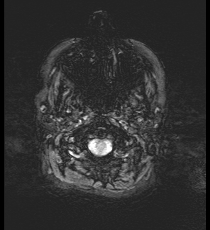 Choroid plexus xanthogranuloma (Radiopaedia 91271-108875 Axial SWI 3).jpg