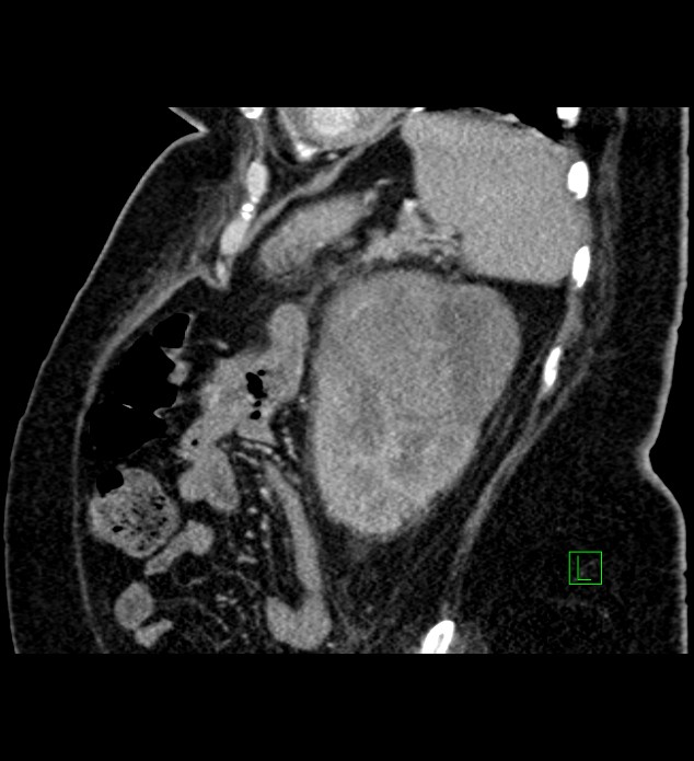 Chromophobe renal cell carcinoma (Radiopaedia 84239-99519 D 30).jpg