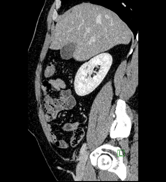 Chromophobe renal cell carcinoma (Radiopaedia 84286-99573 I 131).jpg