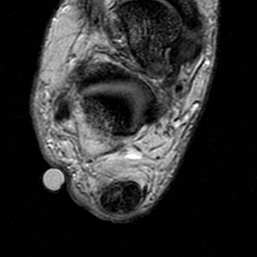 File:Chronic Achilles tendon rupture (Radiopaedia 15262-15100 Axial Gradient Echo 18).jpg