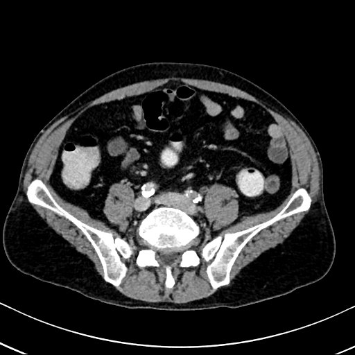 Chronic appendicitis complicated by appendicular abscess, pylephlebitis and liver abscess (Radiopaedia 54483-60700 B 102).jpg