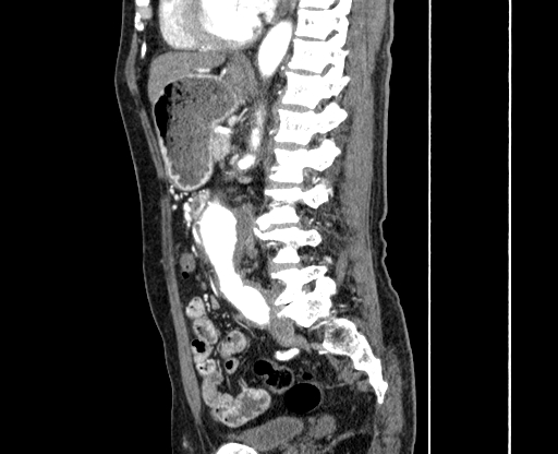 File:Chronic contained rupture of abdominal aortic aneurysm with extensive erosion of the vertebral bodies (Radiopaedia 55450-61901 B 42).jpg