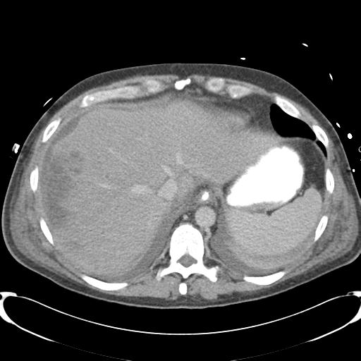Chronic diverticulitis complicated by hepatic abscess and portal vein thrombosis (Radiopaedia 30301-30938 A 15).jpg