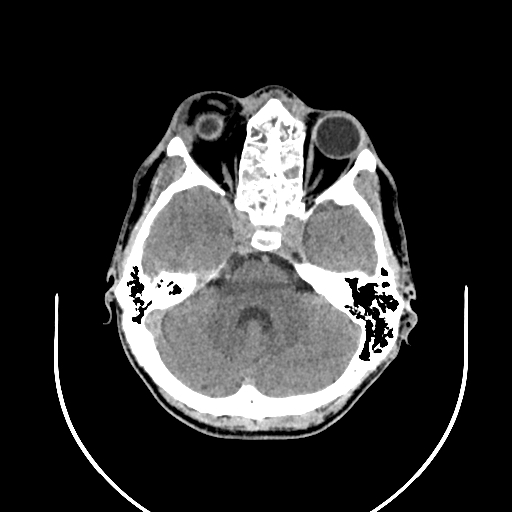 Chronic invasive fungal sinusitis (Radiopaedia 50342-55710 Axial non-contrast 50).jpg