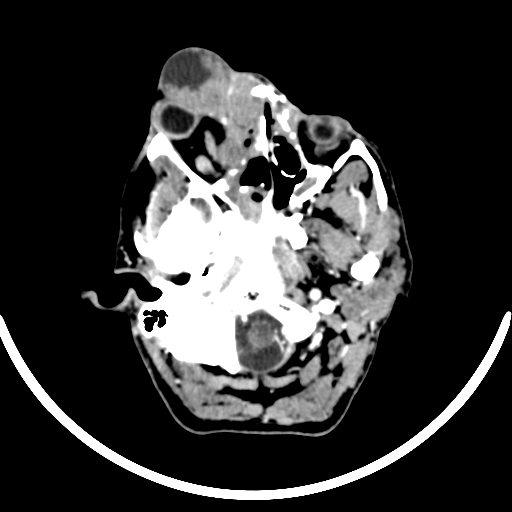 Chronic invasive fungal sinusitis with intraorbital and intracranial extension (Radiopaedia 56387-63046 B 74).jpg