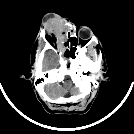 Chronic invasive fungal sinusitis with intraorbital and intracranial extension (Radiopaedia 56387-63046 B 91).jpg