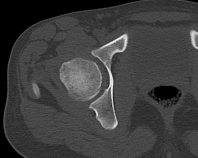 File:Chronic ostemyelitis of the femur with long sinus tract (Radiopaedia 74947-85982 Axial bone window 1).jpg