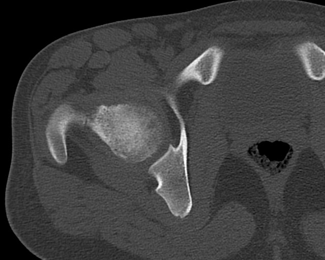 Chronic ostemyelitis of the femur with long sinus tract (Radiopaedia 74947-85982 Axial bone window 3).jpg