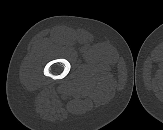 Chronic ostemyelitis of the femur with long sinus tract (Radiopaedia 74947-85982 Axial bone window 48).jpg