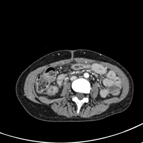 Chronic pancreatitis (Radiopaedia 55405-61846 A 58).jpg