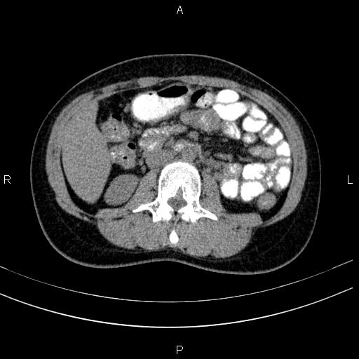 Chronic pancreatitis (Radiopaedia 64576-73450 Axial non-contrast 77).jpg