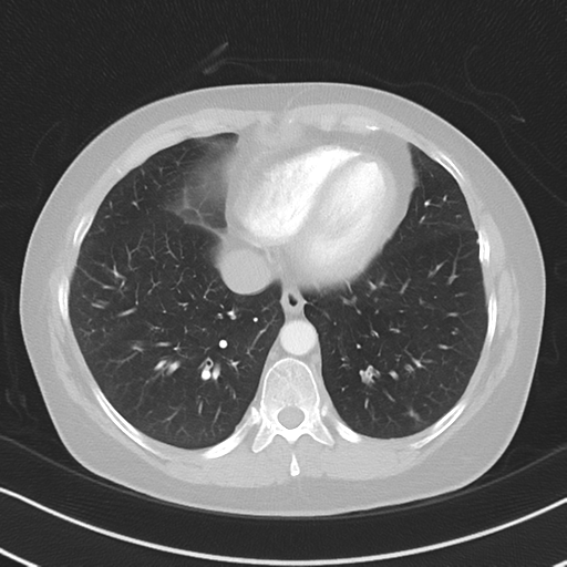 Chronic pulmonary embolus (Radiopaedia 39129-41341 Axial lung window 46).png