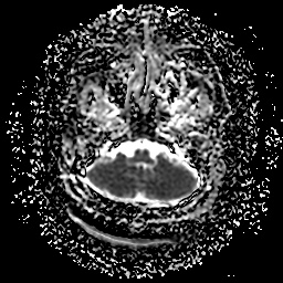 File:Chronic submandibular sialadenitis (Radiopaedia 61852-69885 Axial ADC 4).jpg