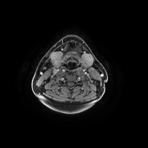 Chronic submandibular sialadenitis (Radiopaedia 61852-69885 Axial T1 C+ fat sat 40).jpg