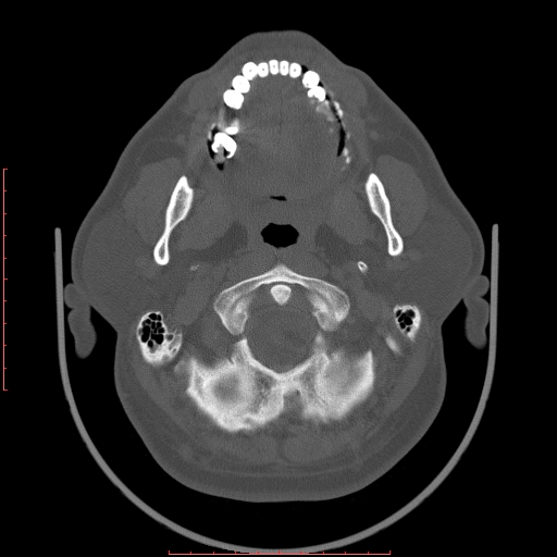 Chronic submandibular sialolithiasis (Radiopaedia 69817-79814 Axial bone window 21).jpg