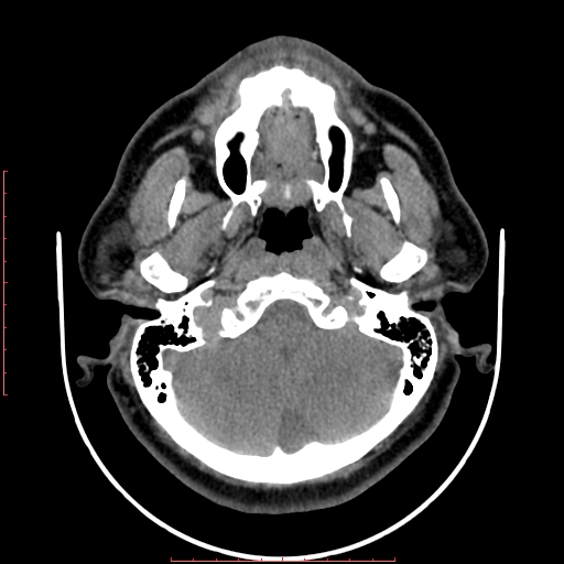 Chronic submandibular sialolithiasis (Radiopaedia 69817-79814 Axial non-contrast 25).jpg