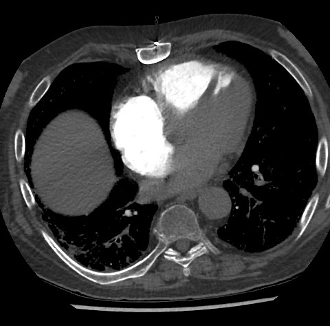 Chronic thromboembolic pulmonary disease (Radiopaedia 90694-108119 Axial C+ CTPA 63).jpg