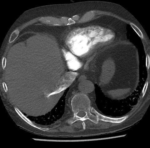 File:Chronic thromboembolic pulmonary disease (Radiopaedia 90694-108119 Axial C+ CTPA 79).jpg