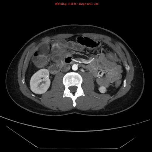 File:Circumaortic left renal vein (Radiopaedia 9069-9792 A 30).jpg