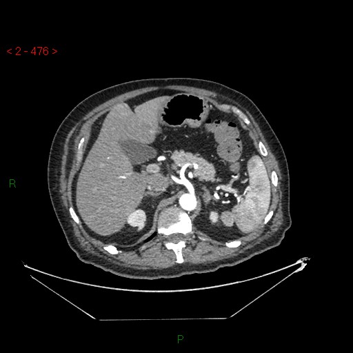 File:Circumaortic left renal vein and doubled left renal arteries (Radiopaedia 52268-58158 A 12).jpg
