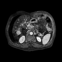 Cirrhosis and hepatocellular carcinoma in the setting of hemochromatosis (Radiopaedia 75394-86594 Axial T1 C+ fat sat 210).jpg