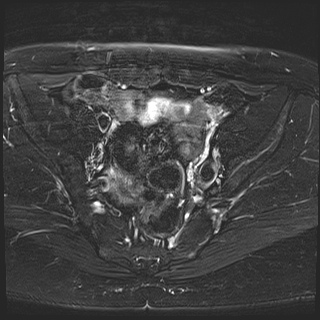 File:Class II Mullerian duct anomaly- unicornuate uterus with rudimentary horn and non-communicating cavity (Radiopaedia 39441-41755 Axial T2 fat sat 12).jpg