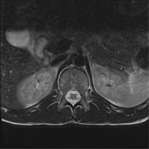 File:Clear cell meningoma - lumbar spine (Radiopaedia 60116-67690 Axial T2 44).png