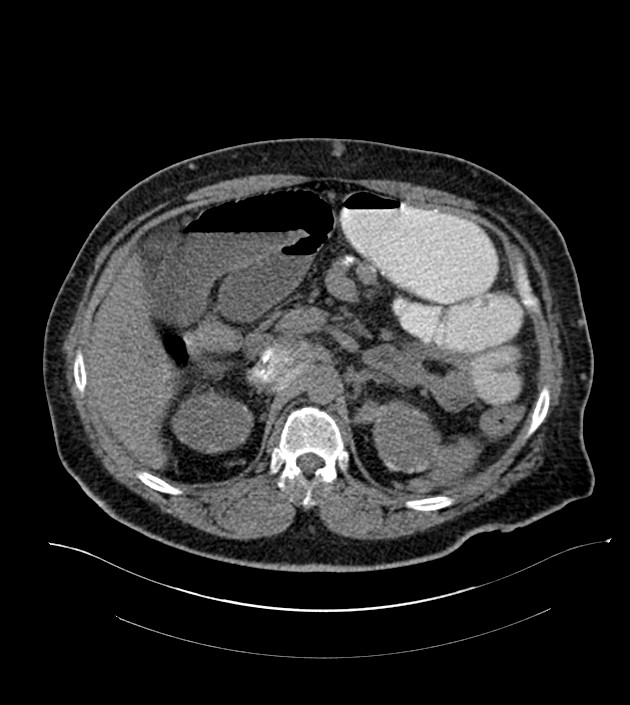 Closed-loop small bowel obstruction-internal hernia (Radiopaedia 78439-91096 Axial non-contrast 49).jpg