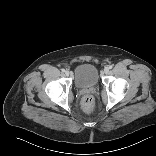 File:Closed loop obstruction - internal hernia into nephrectomy bed (Radiopaedia 59867-67320 Axial 130).jpg