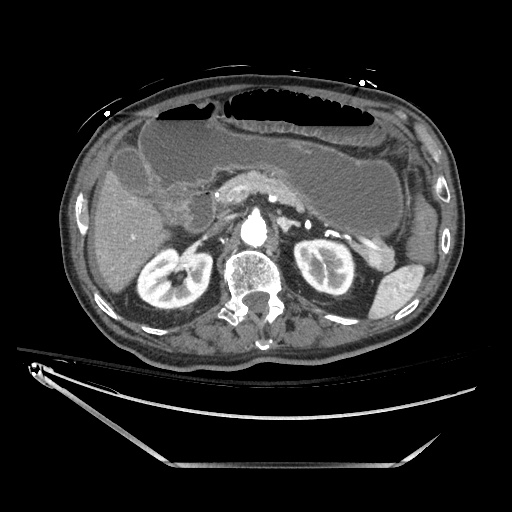 Closed loop obstruction due to adhesive band, resulting in small bowel ischemia and resection (Radiopaedia 83835-99023 B 51).jpg