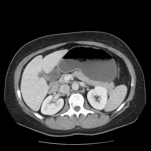 File:Closed loop small bowel obstruction (Radiopaedia 65403-74451 Axial 39).jpg