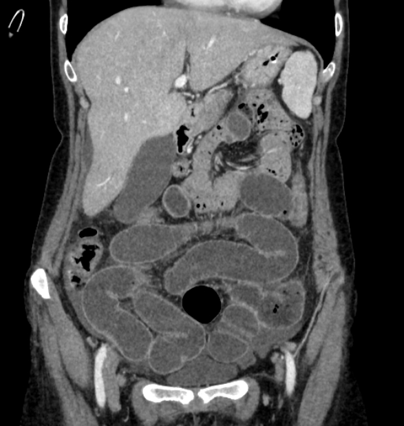 Closed loop small bowel obstruction (Radiopaedia 71211-81508 B 28).jpg