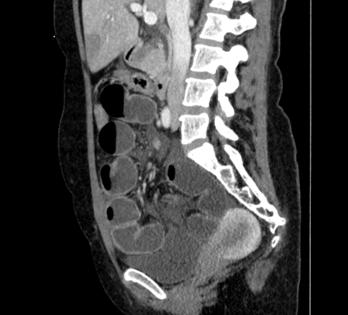Closed loop small bowel obstruction (Radiopaedia 71211-81508 C 63).jpg