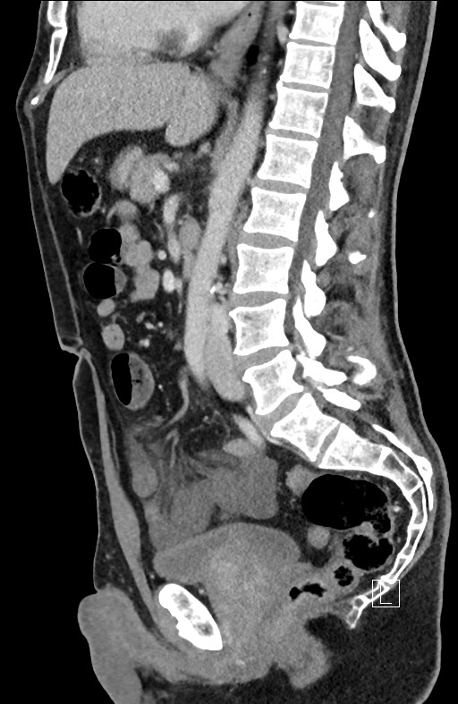 Closed loop small bowel obstruction - internal hernia (Radiopaedia 57806-64778 C 58).jpg