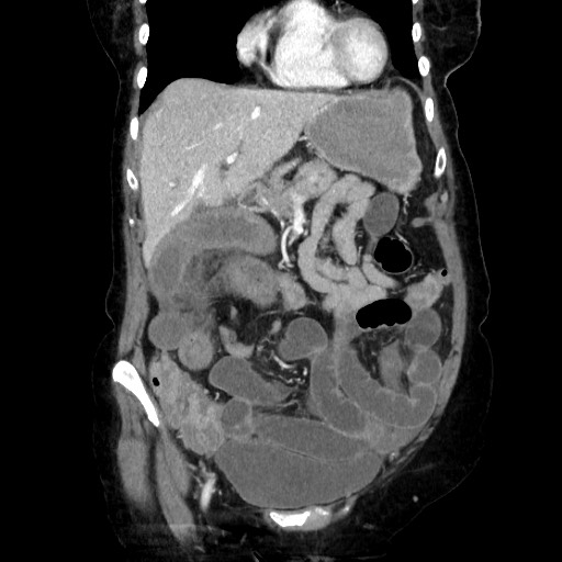 Closed loop small bowel obstruction due to adhesive band, with intramural hemorrhage and ischemia (Radiopaedia 83831-99017 C 43).jpg