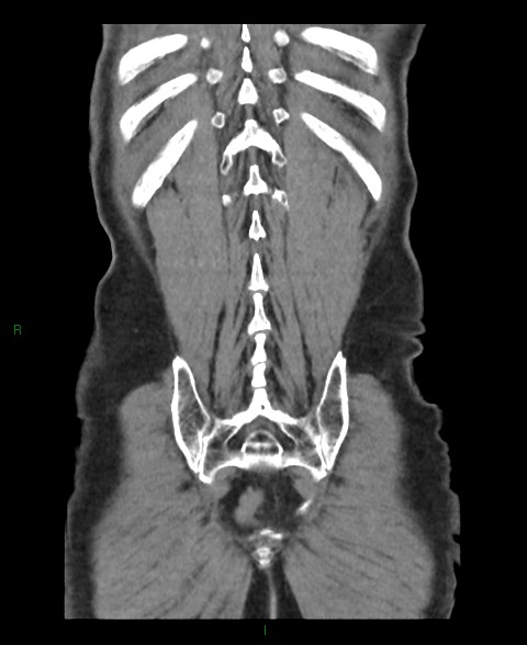 File:Closed loop small bowel obstruction with ischemia (Radiopaedia 84180-99456 B 6).jpg