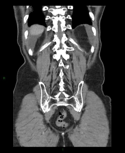 Closed loop small bowel obstruction with ischemia (Radiopaedia 84180-99456 B 9).jpg