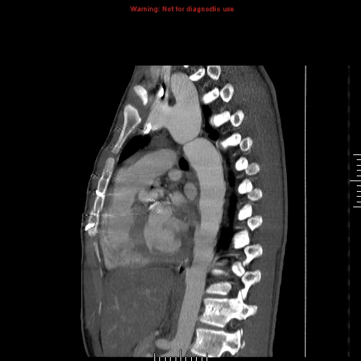 File:Coarctation of the aorta (Radiopaedia 9434-10118 B 34).jpg