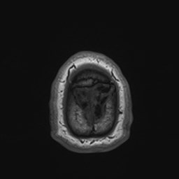 File:Cochlear incomplete partition type III associated with hypothalamic hamartoma (Radiopaedia 88756-105498 Axial T1 186).jpg
