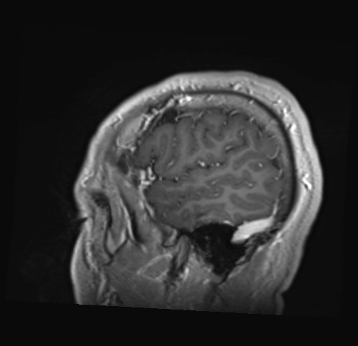 File:Cochlear incomplete partition type III associated with hypothalamic hamartoma (Radiopaedia 88756-105498 Sagittal T1 C+ 9).jpg